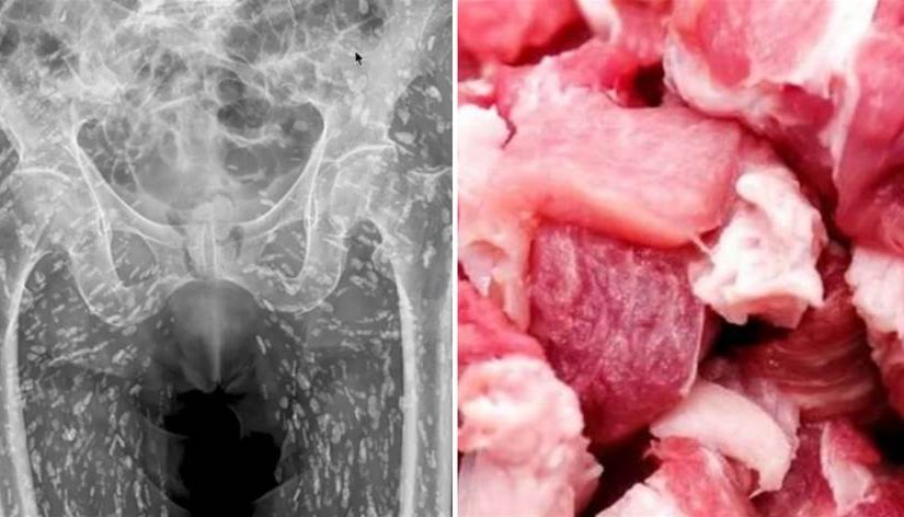男子「吃豬肉」屁股痛！一照X光「整片密密麻麻」嚇傻，醫警告：恐入侵大腦