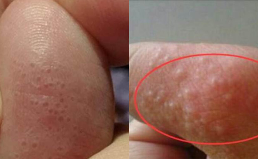 痛苦！手上突然起這種「小水泡」，很癢抓破後有少量液體流出，該怎麼辦？教你一招，很快就好